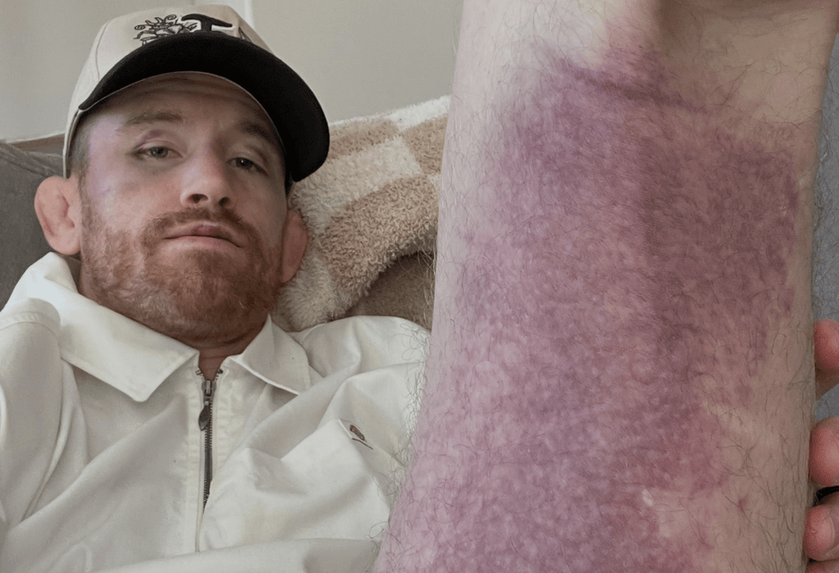 Cory Sandhagen reacts to UFC 329 rematch loss, says he’s worried about a torn hamstring